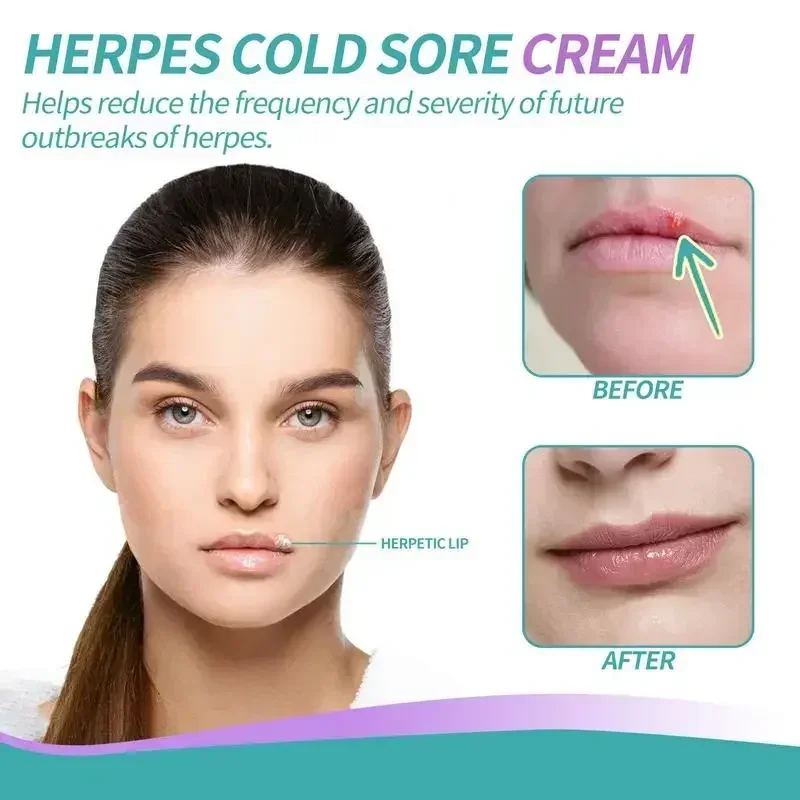 

Крем Cheilitis, восстанавливающий бальзам для губ, восстанавливающий бальзам для губ, внешний крем для кожи, натуральные растительные экстракты, успокаивающий медовый крем для губ