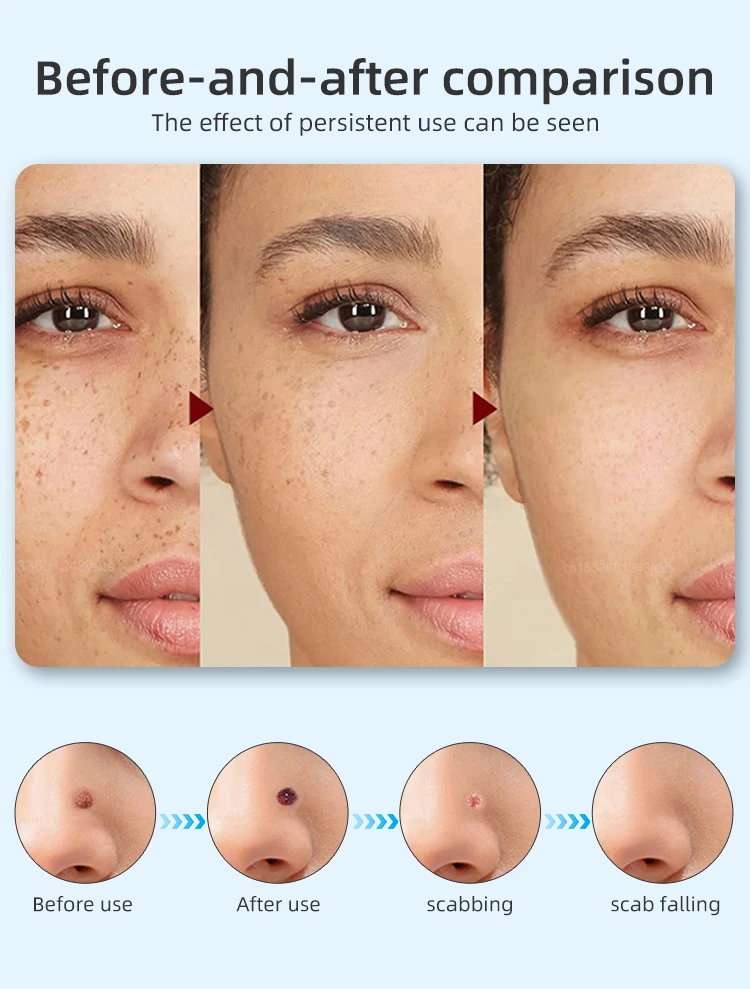 Etichete Picosecundă Laser Plasma Pen Eliminarea aluniței Negi Tatuaj Pistrui Pete întunecate Produse faciale Instrumente de îngrijire a pielii_voghion.com