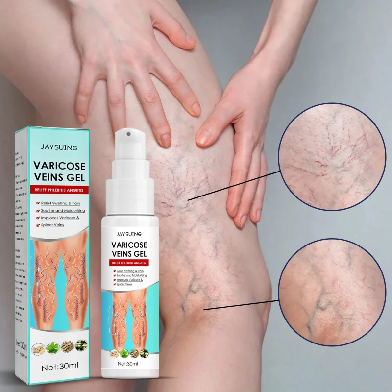 Feet Varicose Veins Cream Treatment Gel Relieve Dilated Capillaries Removal Phlebitis Spider Leg Veins Varicose Cream 30g