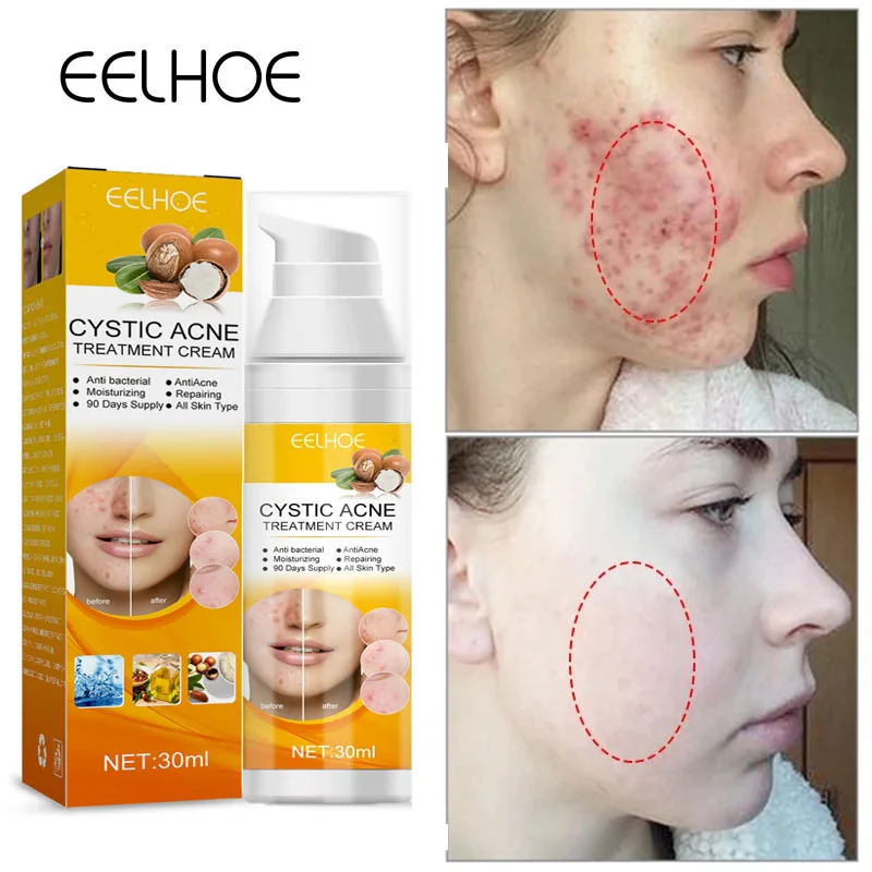 Salicylic Acid Acne Treatment Face Serum Remove Acne Pimples Blackhead
