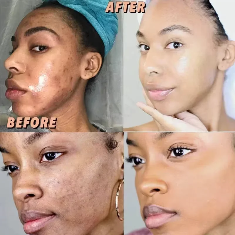 Whitening Serum Cream Fade Melanin Pigmentation Melasma Remove Dark Spots Anti aging Fade Fine Lines Brighten Korean Skin Care whitening body cream facial cream