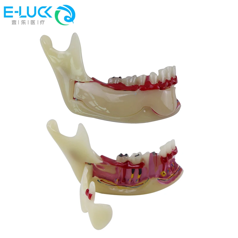 

1 шт., модель стоматологического эндодонтического лечения зубов