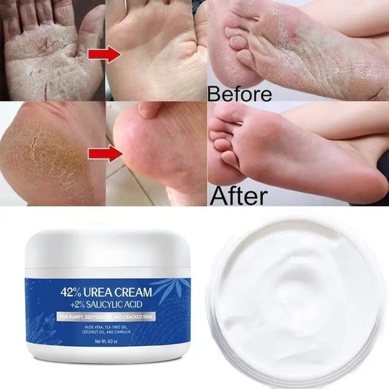 Urea Cream 42 Plus Salicylic Acid 4 Oz, Upgraded Callus Remover Hand