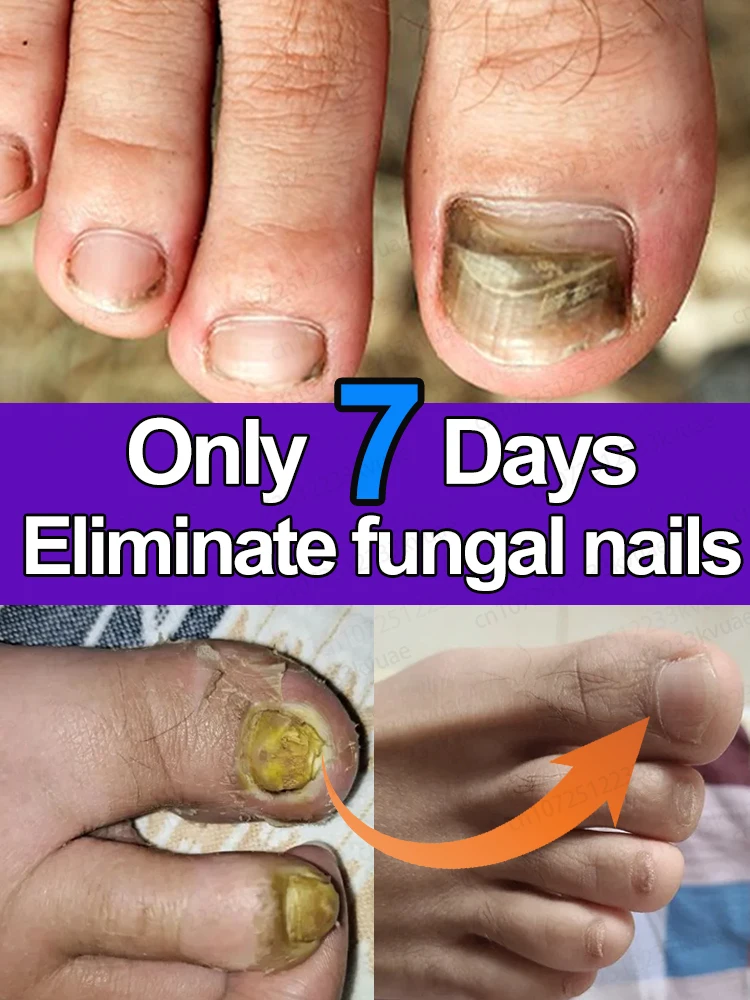 7 jours r&eacute;paration huile d'essence d'ongle produits soins onychomycose fungus solution organic essential oil