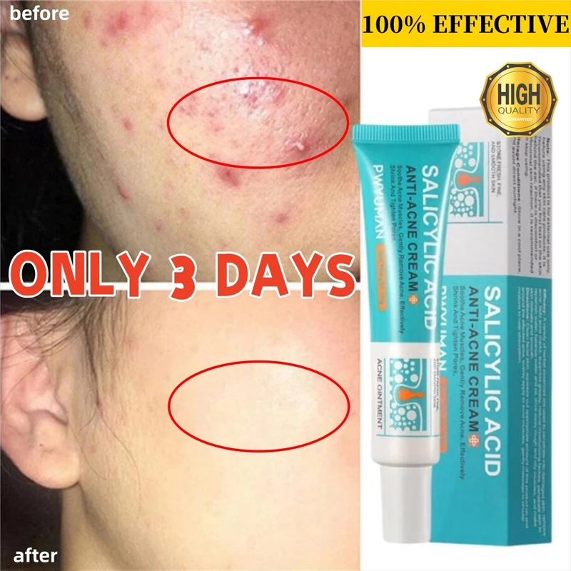 

Salicylic Acid Acne Treatment Cream Anti Pimples Removal Acne Scar Repair Gel Shrink Pore Oil Control Moisturizing Skin Care 30g