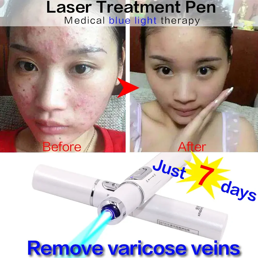 Acne Laser Pen Against Face Remove Varicose Veins Black Dots Blue Light Skincare Anti-Wrinkle Skin Care Beauty Appliances Plasma laser skin treatment