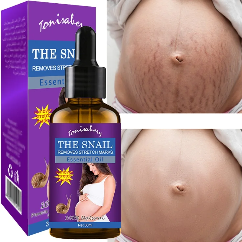 

Stretch Marks Remover Essential Oil Pregnancy Maternity Body New Old Stretch Mark Removal Serum Increase Elasticity of Skin