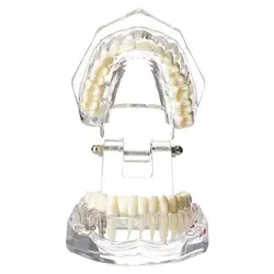 Dental Implant Restoration Bridge Teaching Model - Educational Dental Gift for Professionals and Enthusiasts (1pc)