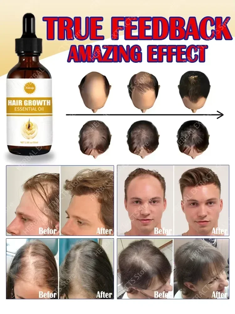 Óleos essenciais que promovem o rápido crescimento do cabelo e tratam a calvície e a queda de cabelo 3