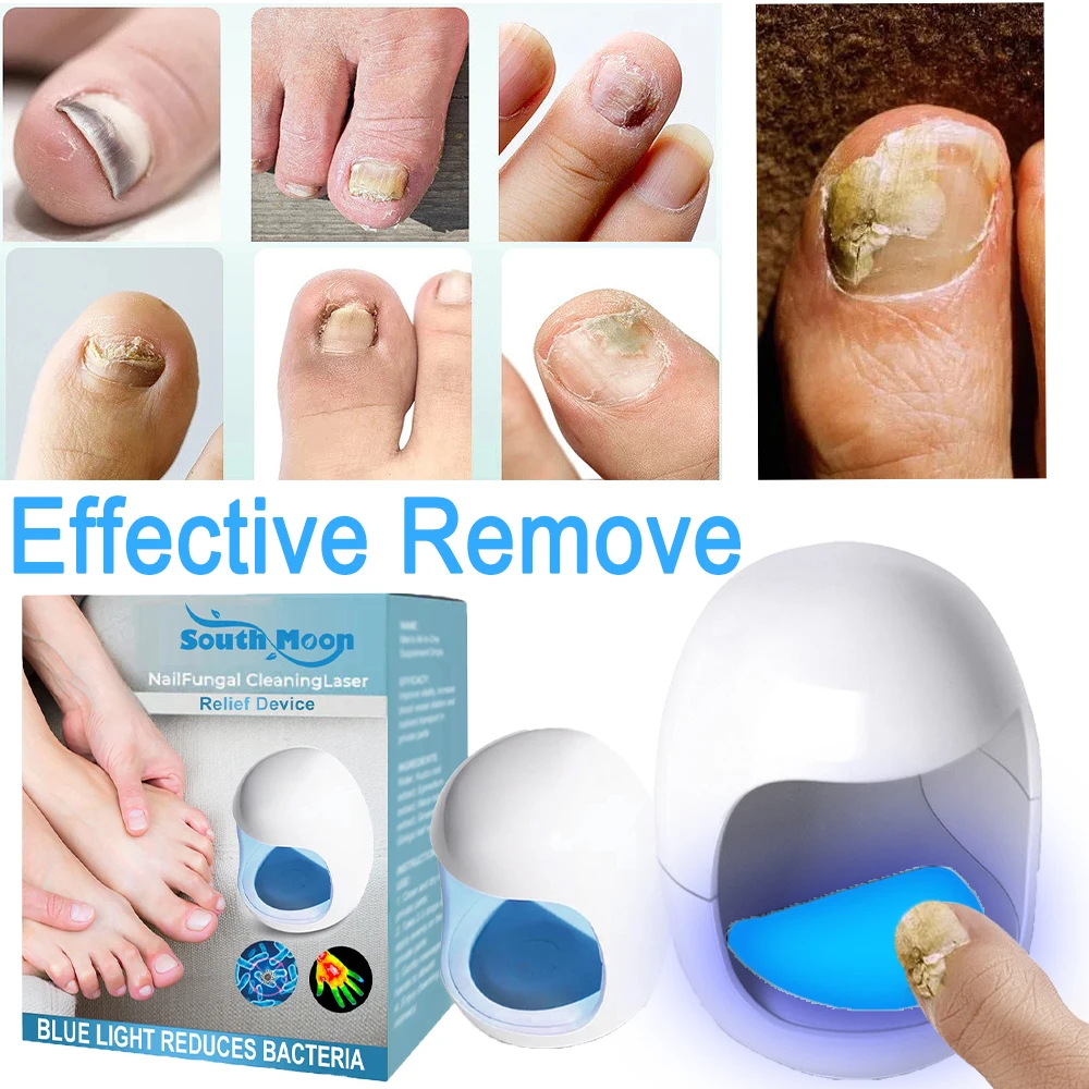 NailFungusLaserTreatmentDeviceRepairToenailFingernailFungus