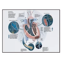 Congestive Heart Failure Horizontal Poster, Heart Failure Awareness Wall Art, Human Heart Medical Wall Decor, Cardiologist Gift