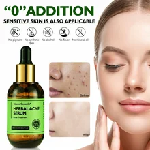 

Acne Treatment Serum Natural Herbal Acne Serum Fast Acne Marks Removal Oil Control Skin Brightening Essence Facial Treatment