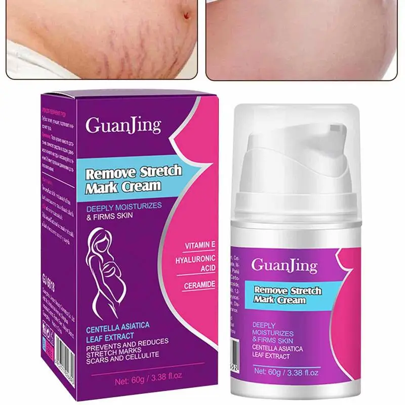 StretchMarkCreamForPregnancyScarRemovalCreamForOldScars