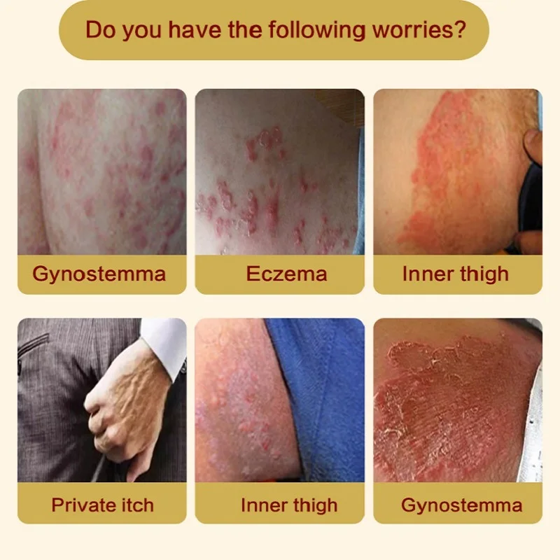 Antibacterial Psoriasis Cream Herbal Effective Anti-itch Relief Dermatitis Eczema Treatment Urticaria Desquamation Skin Care