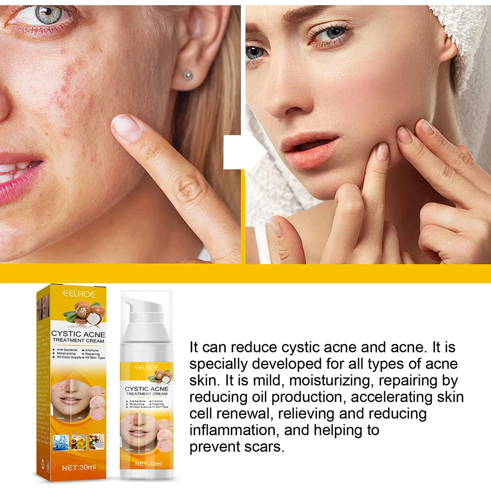 30ml crema per la rimozione dell'acne cistica Anti-Acne idratante  riparazione sbiancante siero viso ad assorbimento rapido cura della pelle  per adolescenti adulti - AliExpress