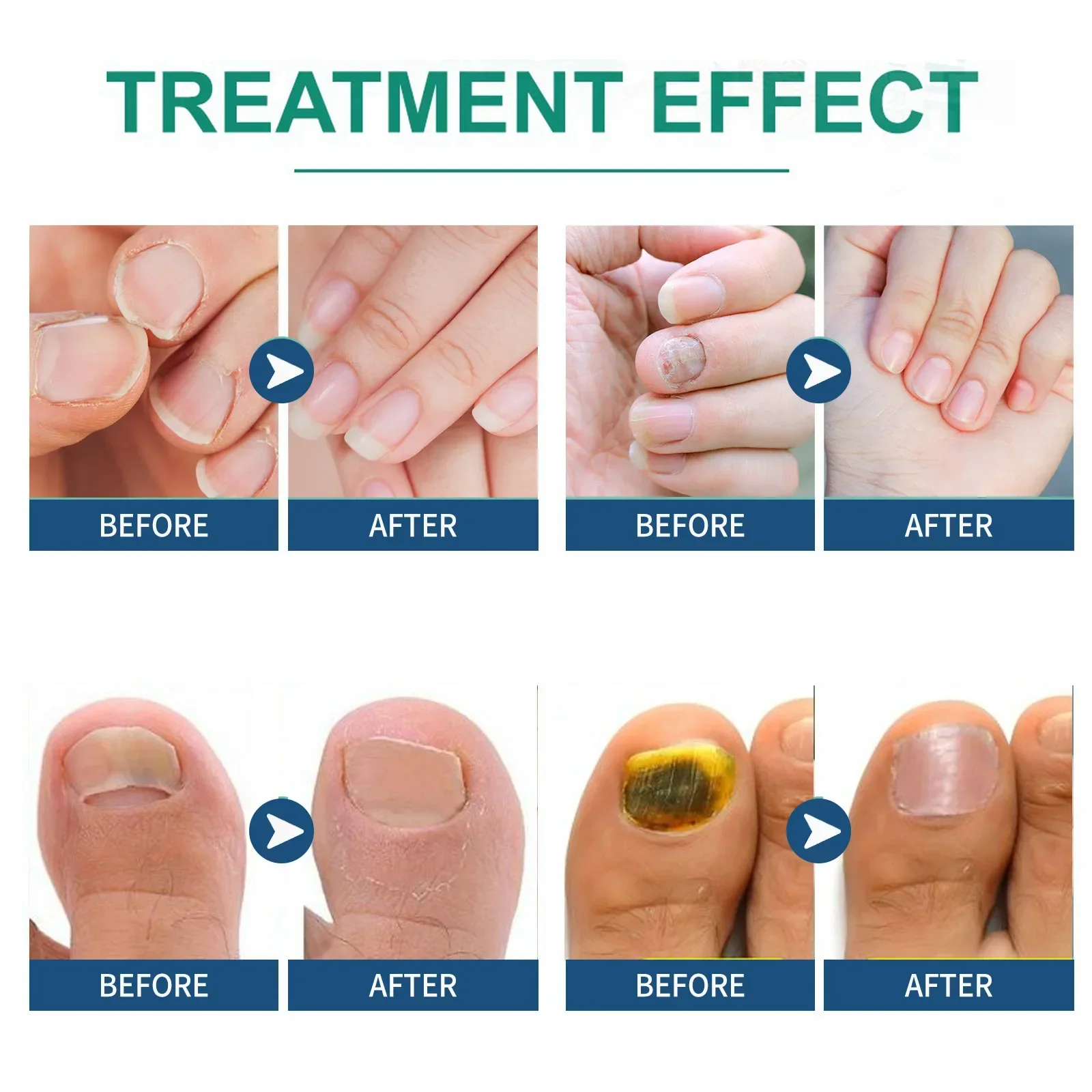 EELHOE Nail Treatment Patch Ingrown Toenail Corrector Repair Grey Nails Paronychia Anti Fungal Infection Nail Care Sticker 32pcs