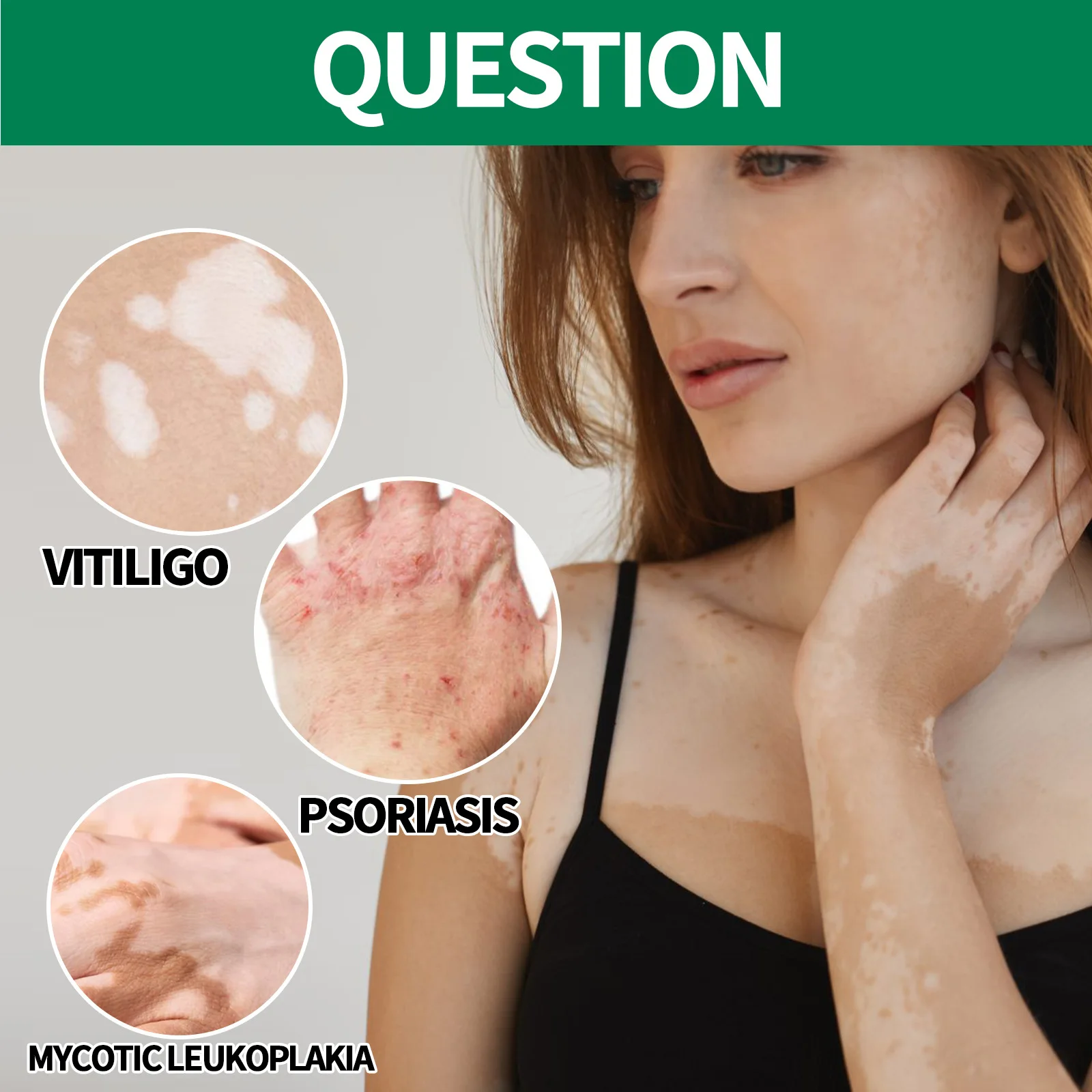 Piebaldism Vs Vitiligo