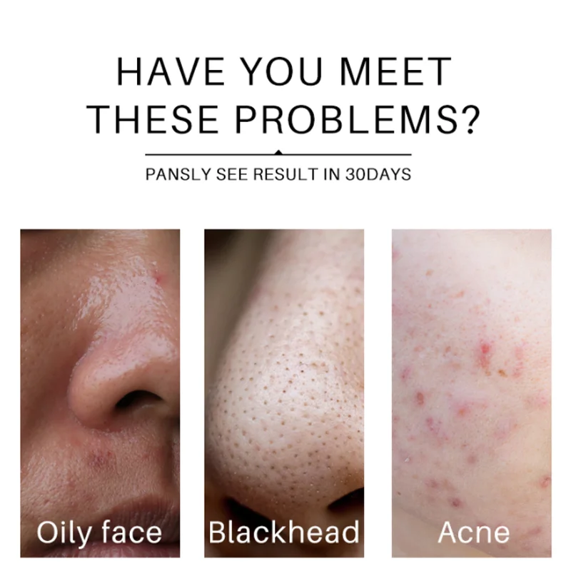 Amino Acid Oil Controlling Acne Facial Cleanser Gentle Cleansing Skin Moisturizing Plant Extract Double Tube Facial Cleanser 80g 4