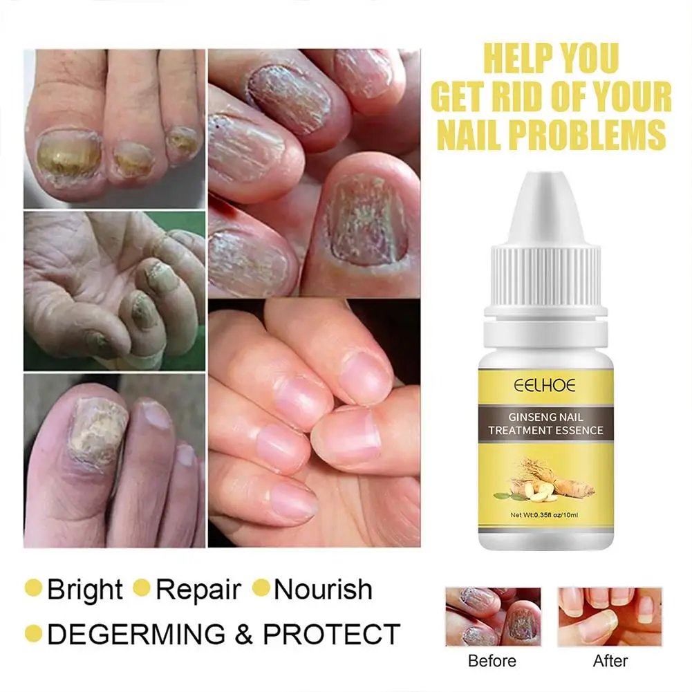 Nail Fungus Removal Cream Onychomycosis Fungal Nail J4D6 Feet Ointment Fungal Treatment Infection Anti Care Toe Paronychia X0D7