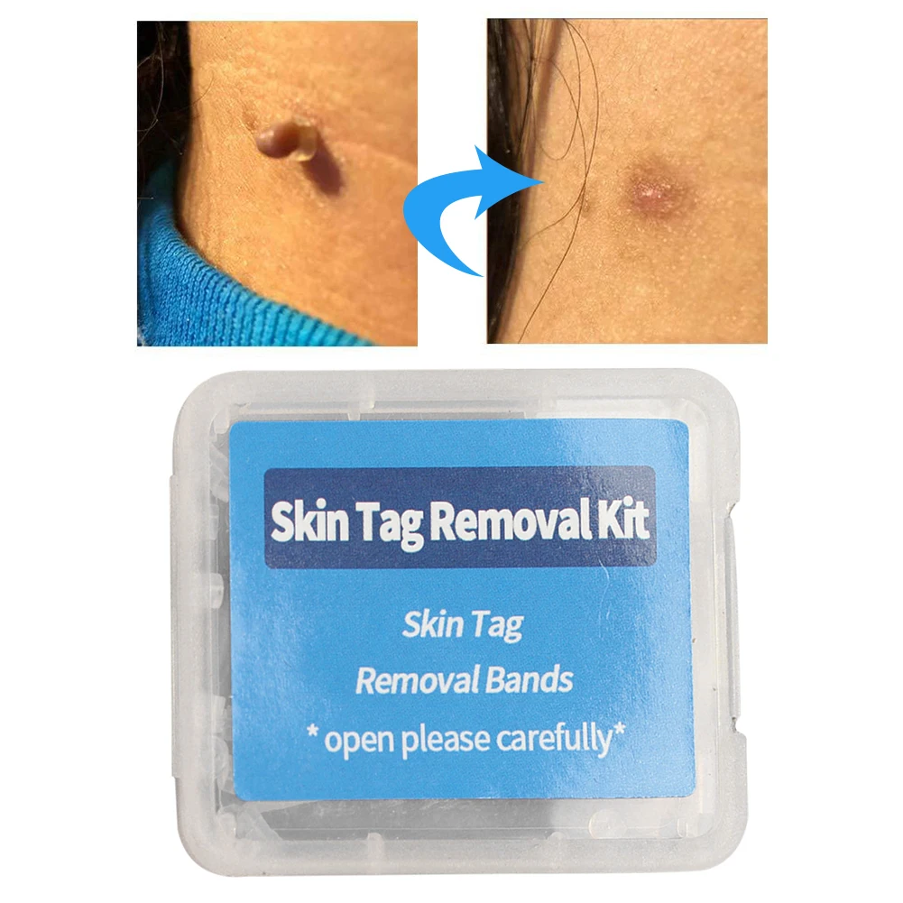 Warts Acne Pimple Treatment Kits 4