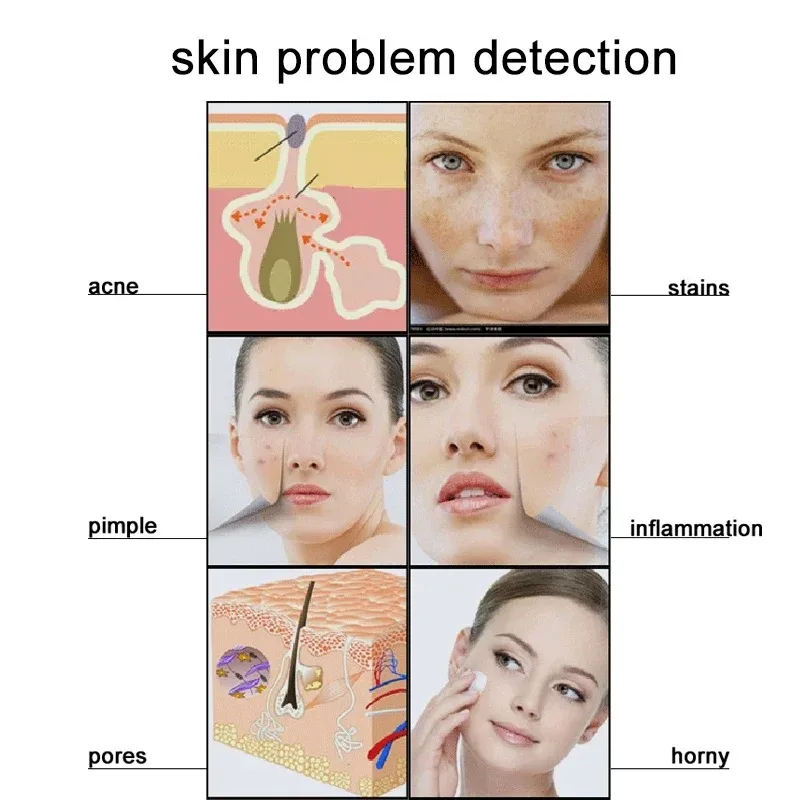 50X/200X Hair Follicle Scalp Skin Analyzer Detection Magnifying Microscope LCD Digital Dermatoscope Scalp Hair Detector Tester