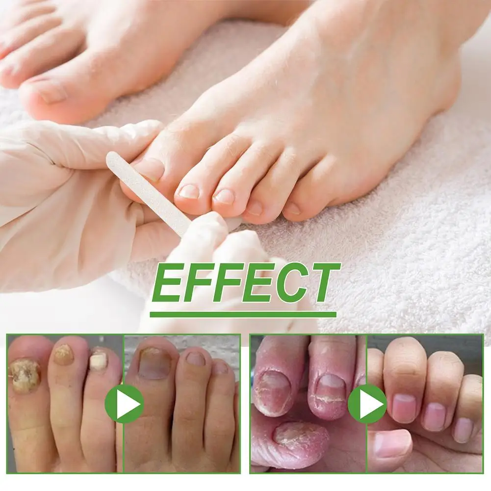 5 Days Nail Growth And Hardening Repair Roller Nail Repair Softening Removing Thickening Brightening Nutrient Solution nail growth solution