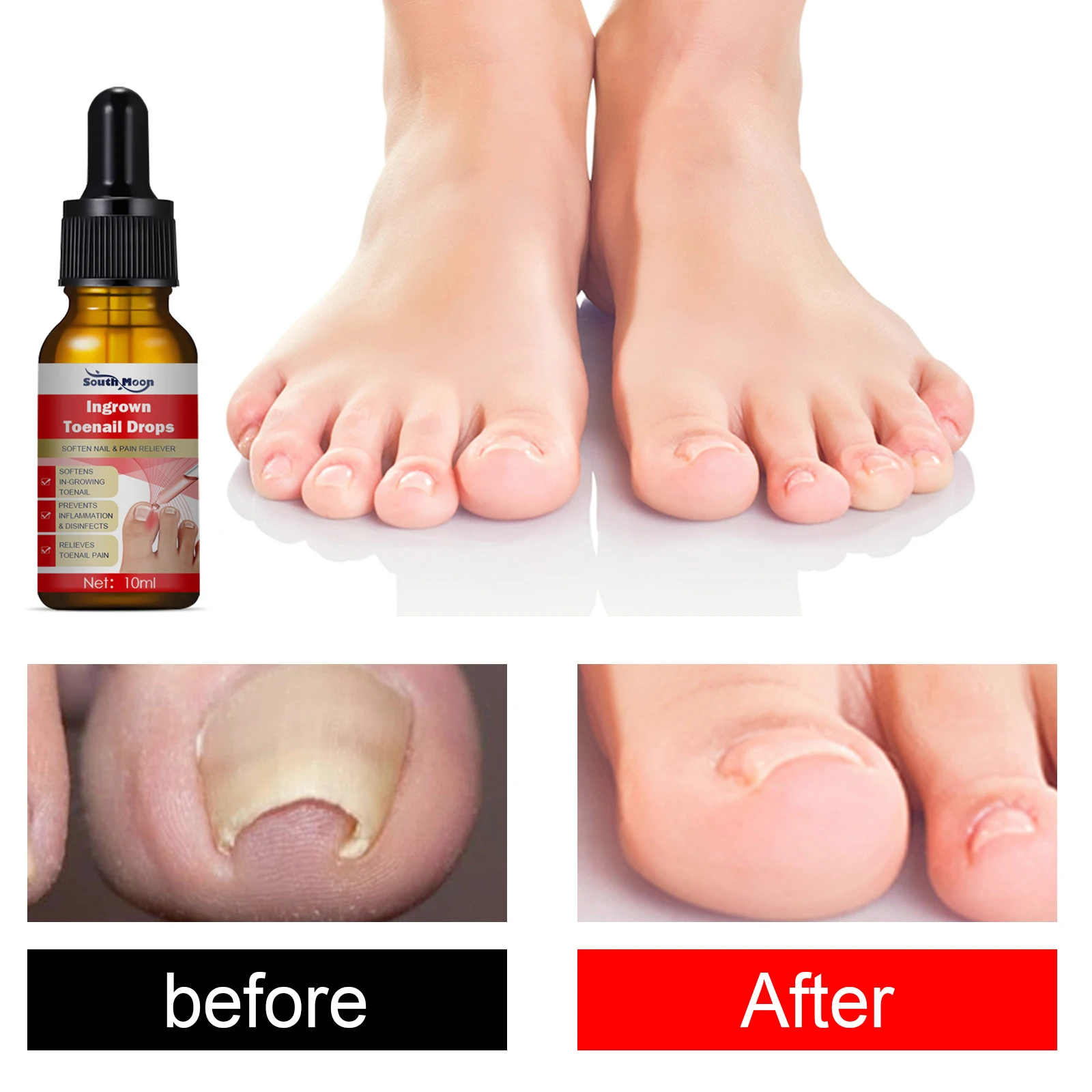 

10ml Ingrown Toenail Treatment Serum Nail Correction Recover Oil Pain Reliever Nail Softener Trim With Ease Oil Feet Health Care