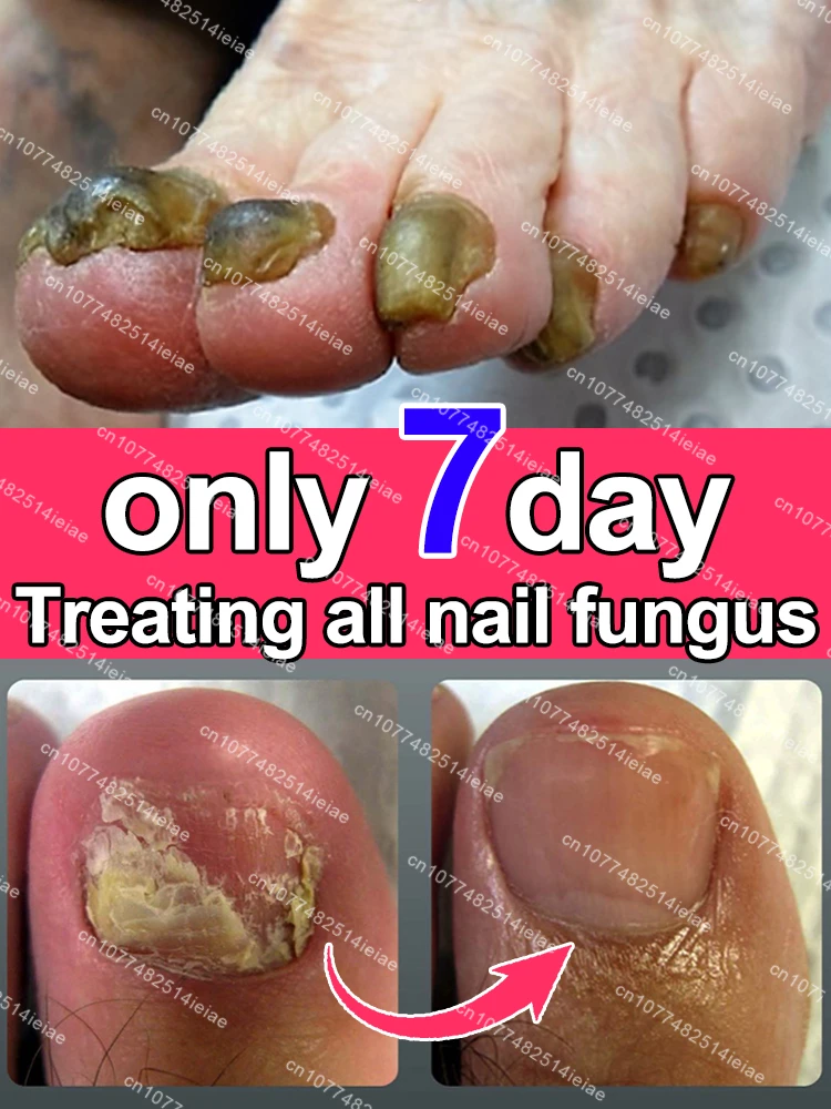 Nail fungus treatment essential oil, repair onychomycosis in 7 days