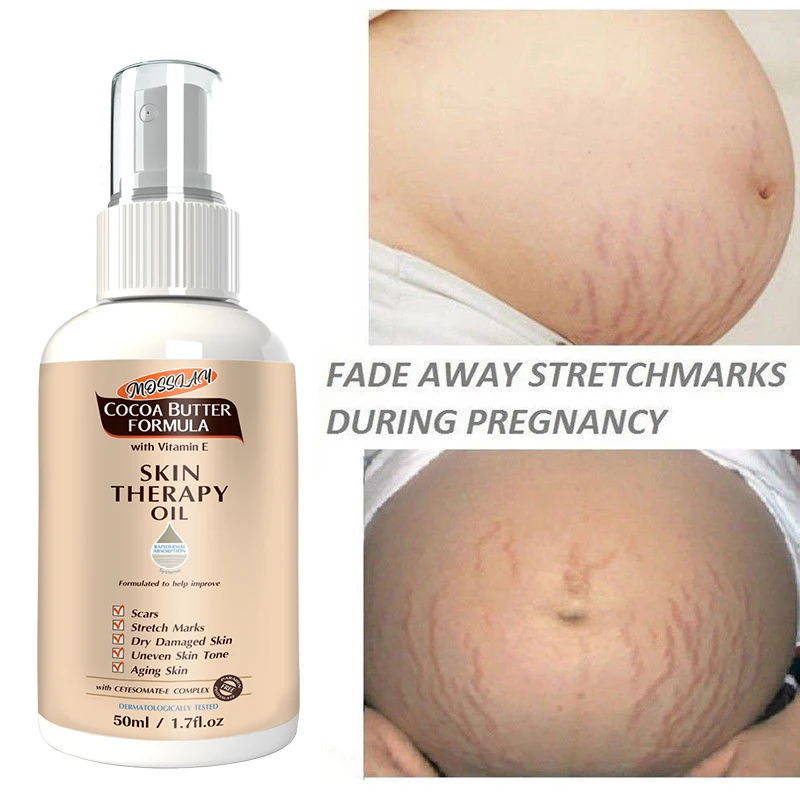 Stretch Mark Spray  Repair  Removal Acne Scar Stretch Marks Cream Fat Scar Striae Gravidarum Treatment Streaks Obesity