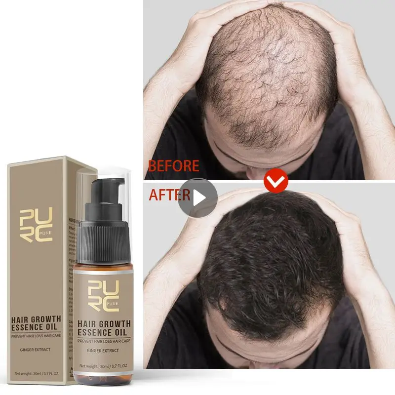 

Рост волос подходит для всех типов волос истончение волос стимуляция волосяных фолликулов мощный чудо Уход за волосами здоровый выпадение волос