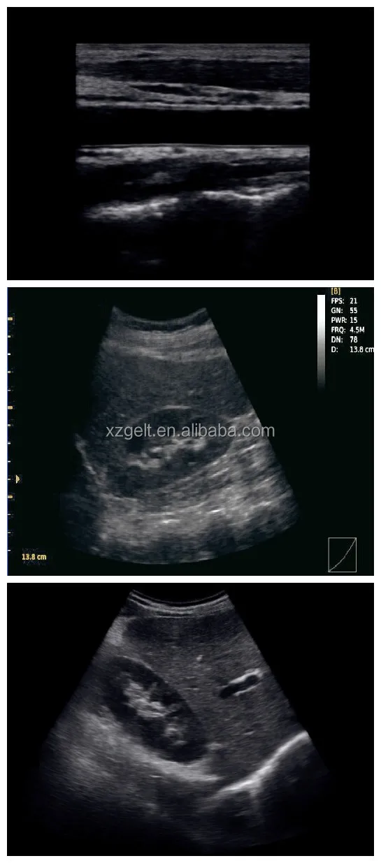 Ecógrafo Portátil Doppler Color Mindray - ALLMEDICA Equipos Médicos