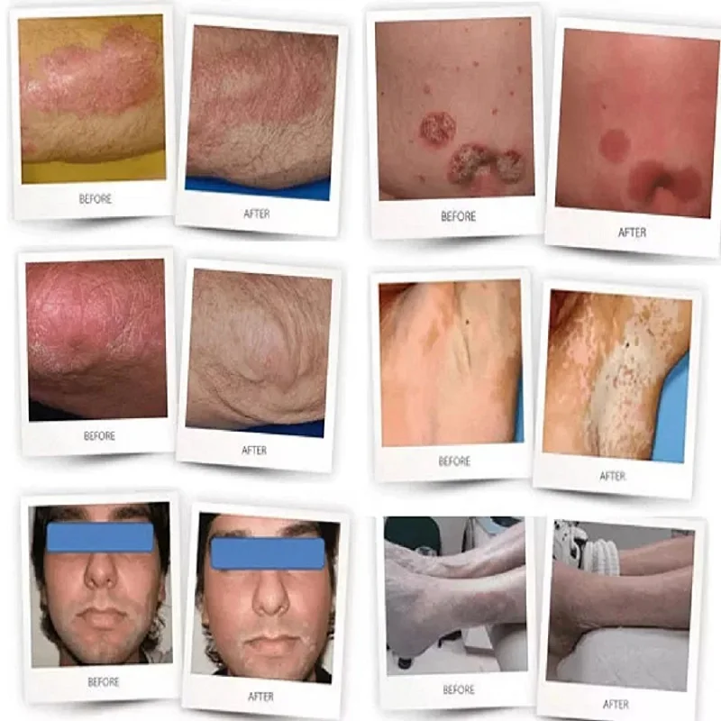 UVB Lamp for Therapy Psoriasis Lamp Skin Treatment Light 308NM Narrowband Ultraviolet Vitiligo Phototherapy Instrument - Image 5