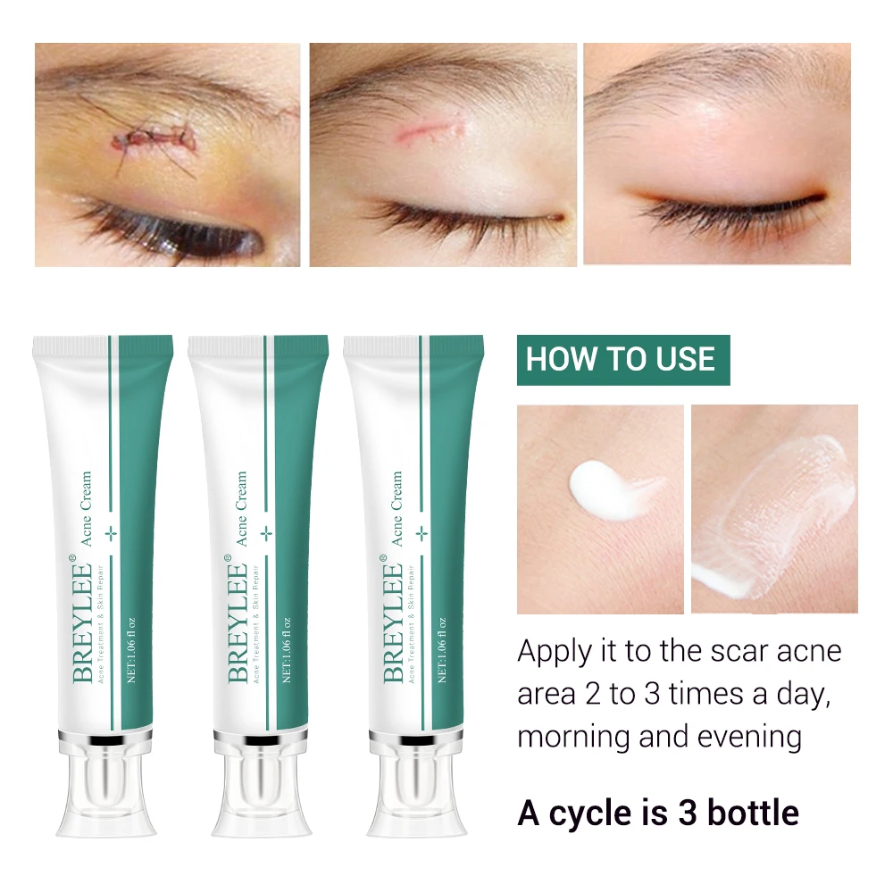 Scar Removal Cream Stretch Marks Acne Scars Skin Repair Dark Spot Remover Face Skin Care face cream,skin cream