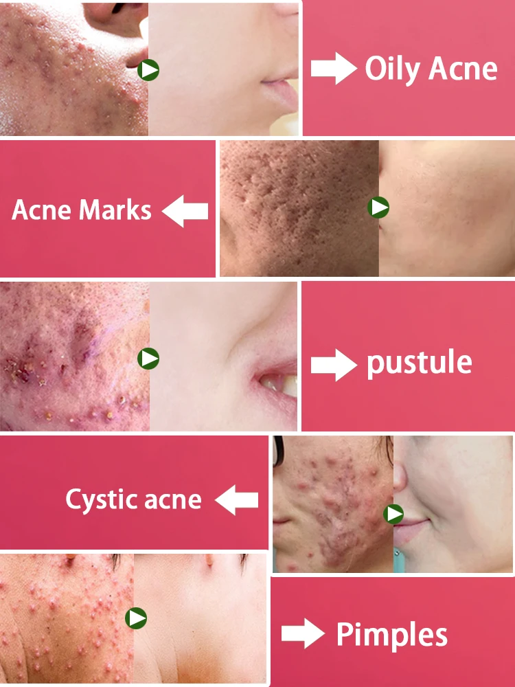 Crema para eliminar el acn&eacute; y las marcas de acn&eacute;, extracto de hierbas, eficaz, antiinflamatoria, reparaci&oacute;n la piel, control
