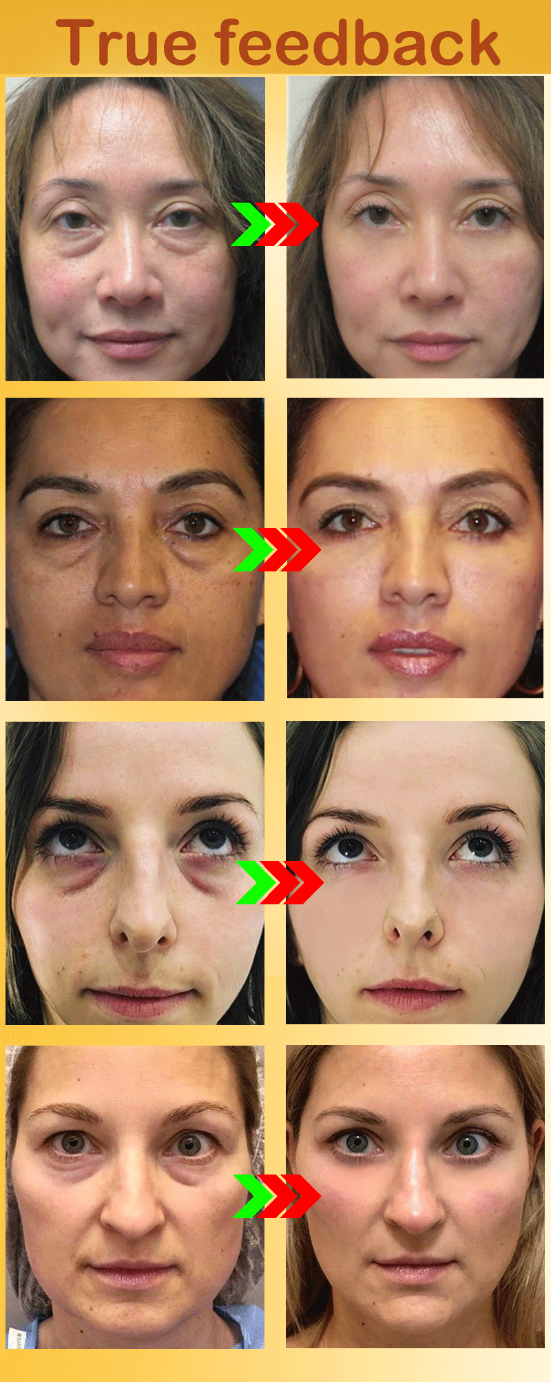 Eye Cream Dark Circles And Bag Removal For Anti Bags In The Eyes Under  Contour Area - AliExpress