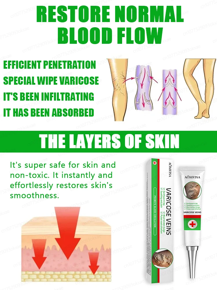 Effective Varicose Vein Relief Cream Ointment For Varicose Veins To Relieve Vasculitis Phlebitis
