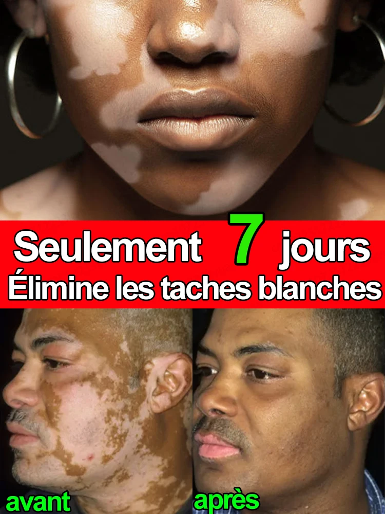 Photo inspiration: Cr Me De Traitement Du Vitiligo Pour Soulager L Limination Photo Inspiration