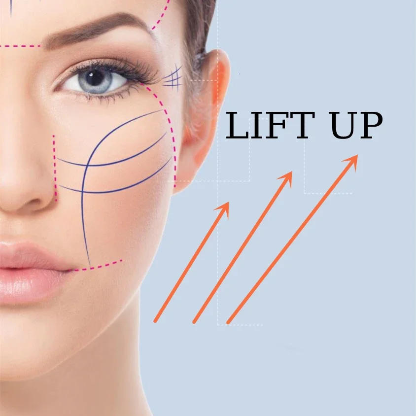 

Top Quality ELLASUPER Strong Lift Up Wires 18G Tool for Cheeks Face Forehead Nose Eyebrows Chin Eye Around Nasolabial folds