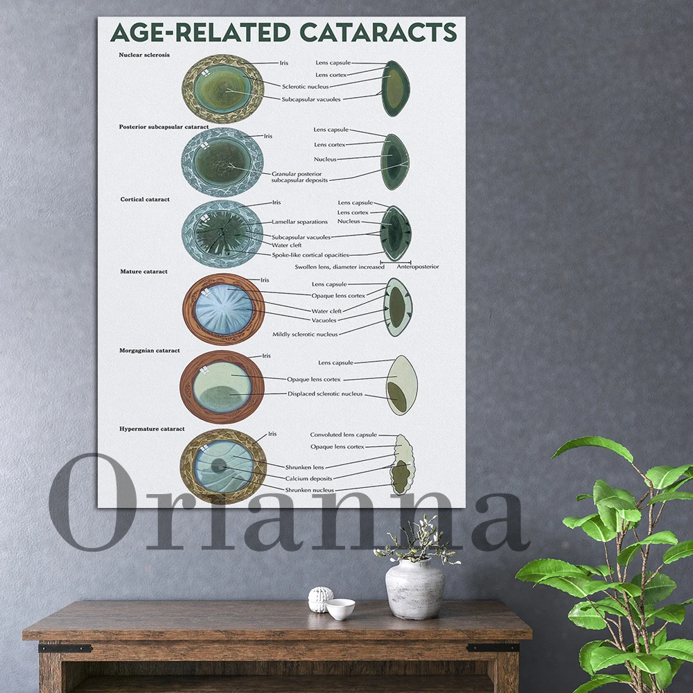 

Eye Related Cataracts Canvas Poster, Cataract Awareness Wall Art, Eye Health Wall Decor, Eye Disease Anatomical Chart Art Print