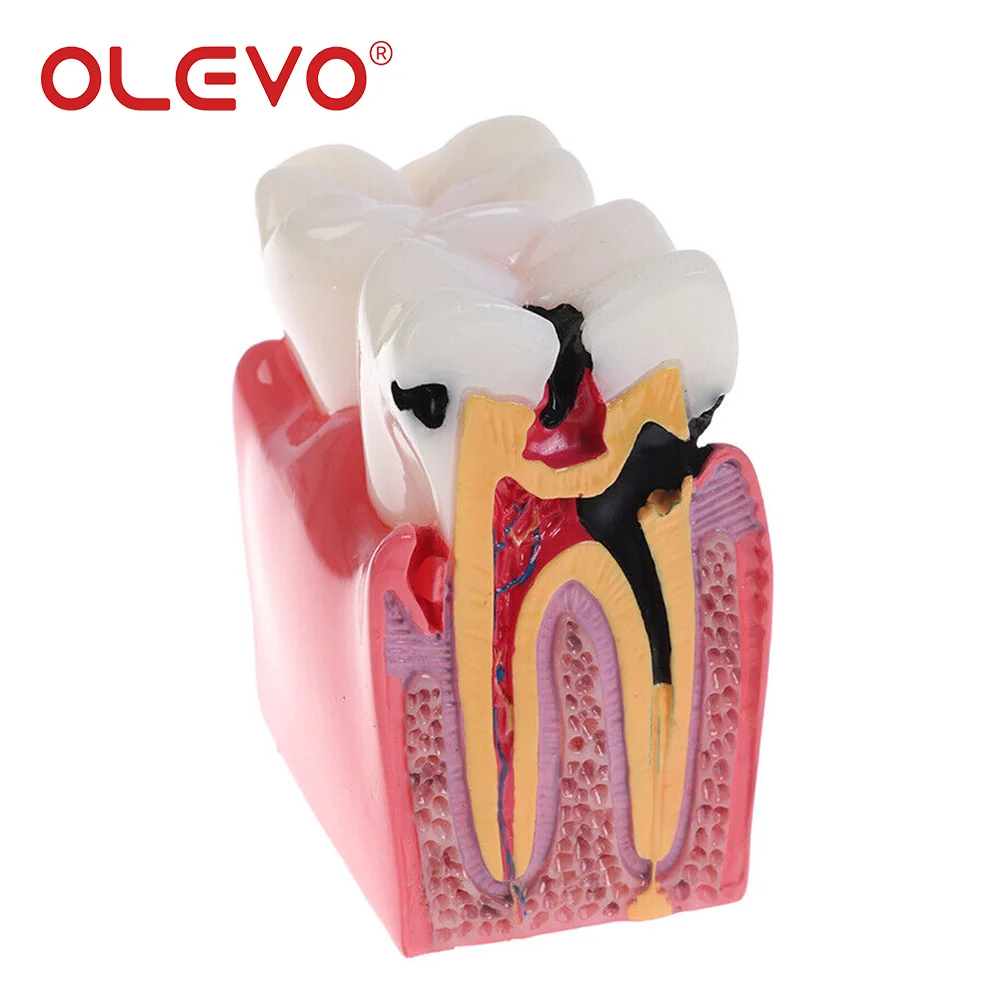 OLEVO 치과 교육 치아 모델 6 배 우식 비교 데모 학생 공부 치과 실험실 훈련 틀니 모델