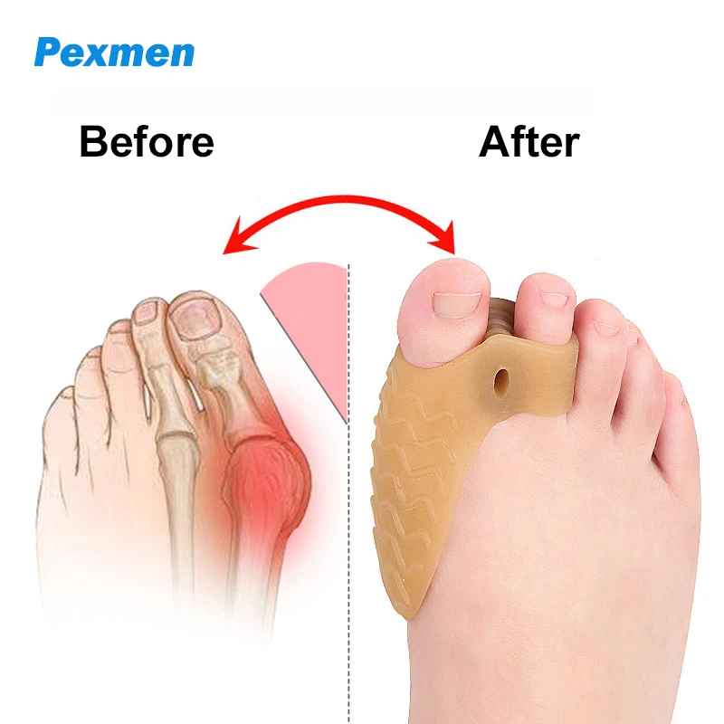 Pexmen 2Pcs Bunion Pad Bunion Cushions Protectors Toe Separator Spacer for Big Toe Bunion Relief with Gel Shield Foot Care Tool 2pcs 5pcs 10pcs mb 15ak 14ak mig mag gas ceramic nozzle euro style welding gun tip nozzle shield cup for welding torch