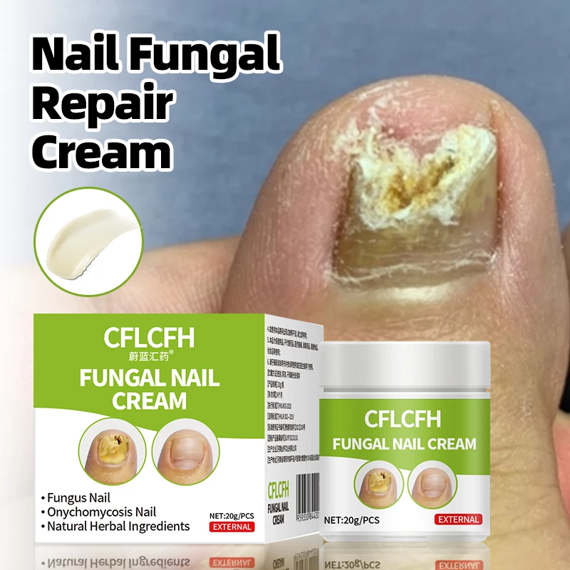 

Fungus Nail Repair Cream Toe Fungal Nail Onychomycosis Removal Anti Infection Correction Paronychia Treatment Ointment Foot Care