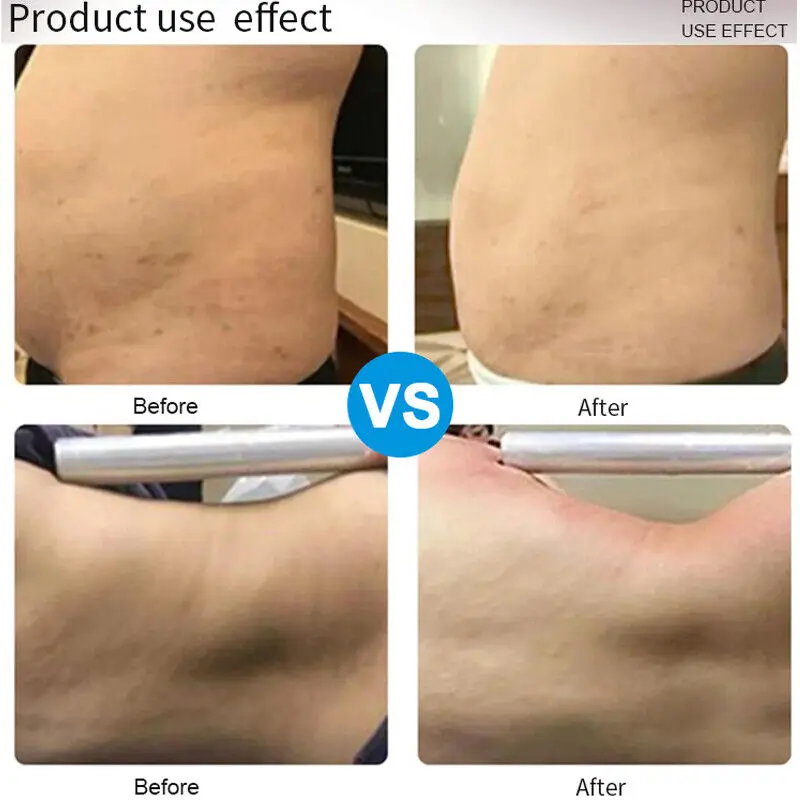 Lipolaser Slimming Machine With 14 Lipo Laser Pads 9 <h3 class="features--headline">Features and benefits</h3> Lipolaser Treatment Is A Non-Invasive Treatment Safe For Body Contouring Lipo Laser Machines Benefits Fat Reduction Cellulite Reduction Body Sculpting 14 Laser Pads 5mw 635nm-650nm Lipo Laser Fat Burning Cellulite Removal Laser Lipolysis Improves Body Shape And Contour And Reduces Circumference <hr /> <h5></h5> <h5><span class="tw-text-2xl tw-font-bold" style="color: #99ccff;">IN STOCK READY TO SHIP</span></h5> <h5><span class="tw-text-2xl tw-font-bold" style="color: #99ccff;">1 YEAR WARRANTY + 3 YEAR TECH SUPPORT</span></h5> <h5><span class="tw-text-2xl tw-font-bold" style="color: #99ccff;">30 DAY MONEY-BACK AND <a href="https://salonmachines.com/refund_returns/">RETURN POLICY</a></span></h5> <h5><span class="tw-text-2xl tw-font-bold" style="color: #99ccff;">FREE WORLDWIDE SHIPPING <a href="https://salonmachines.com/shipping-policy/">SHIPPING POLICY</a> </span></h5> <h5><span class="tw-text-2xl tw-font-bold" style="color: #99ccff;">PROFESSIONAL BEAUTY <a href="https://salonmachines.com/">SALON MACHINES</a> EQUIPMENT</span></h5> <div class="product-block product-block--sales-point"></div> Lipolaser Slimming Machine With 14 Lipo Laser Pads