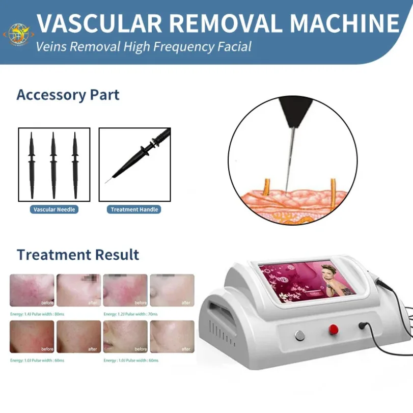

Red Blood Vessels Removal Treatment Machine Spider Veins R-F High Frequency Blood Vascular Removal Machine Beauty Equipment