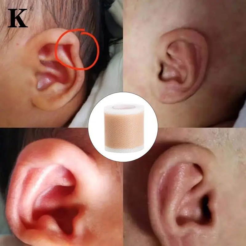 1Roll Baby Ear Corrector Infant Protruding Ears Correction 4x 50cm Silicone Kids Ear Aesthetic Correctors Patch Sticker Care medical ear patch ear protector stickers earlobe stickers