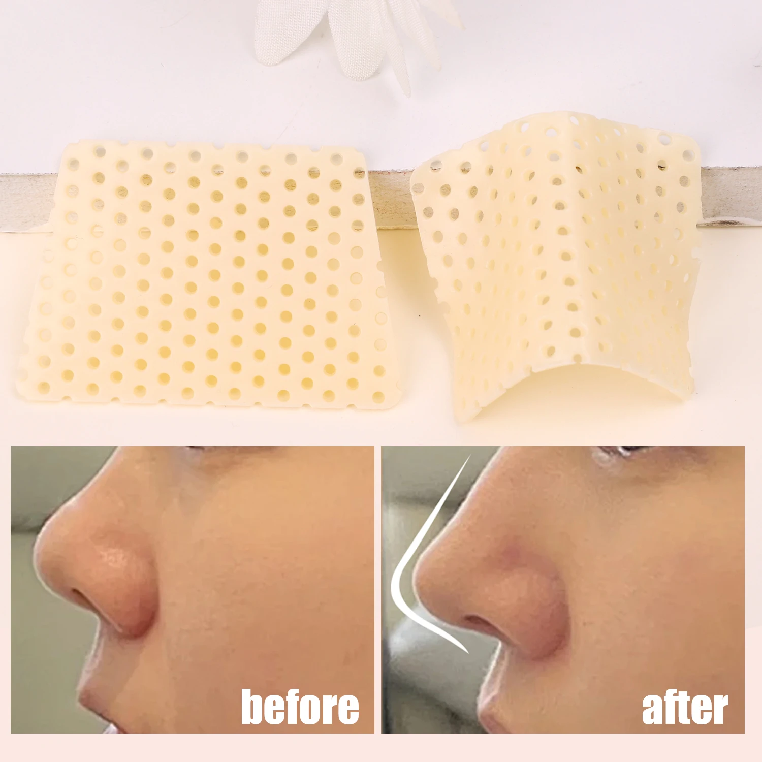 Thermoplastic Nose Splint for Fracture Support and Fixation