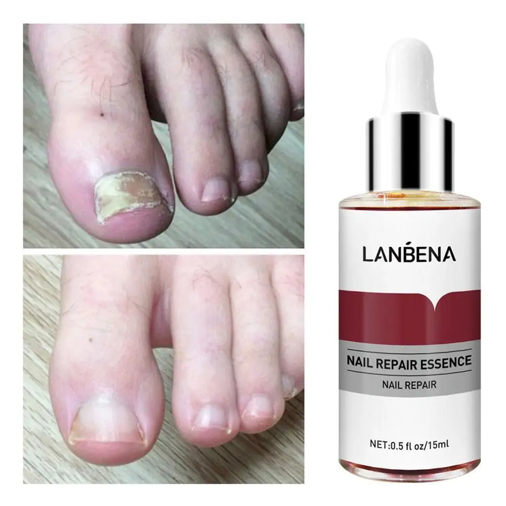

Эссенция LANBENA для восстановления ногтей, сыворотка для лечения Ногтей, гель для удаления грибка ногтей, против паронихии и онихомикоза