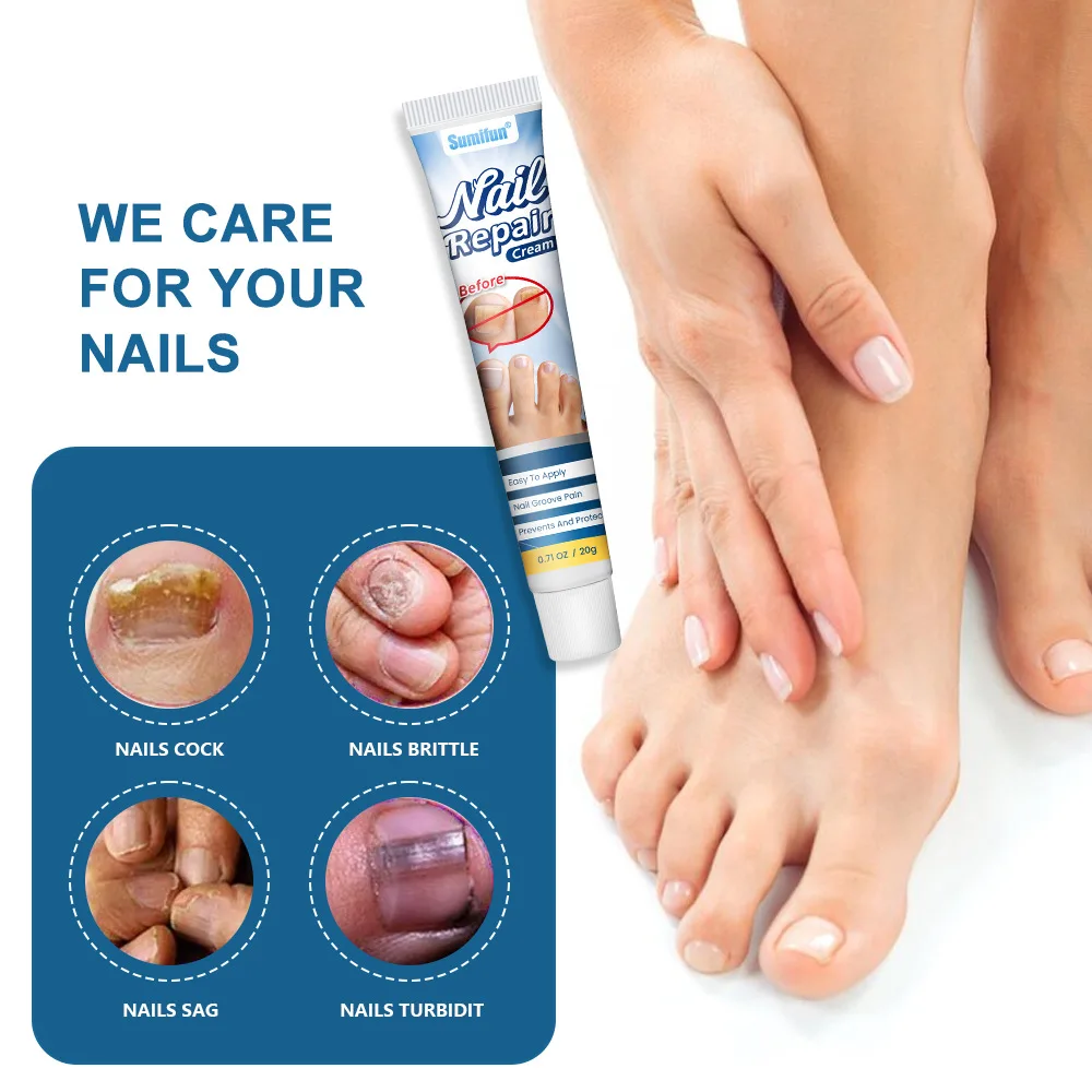 Nail Fungus Treatment Cream Foot Toe Nail Fungus Removal Serum Anti-infection Paronychia Onychomycosis Repair Gel Care U&ntilde;as