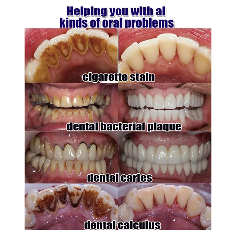 Whitening Teeth Remover Dental Calculus Mouth Odor Removal Bad Breath Preventing Periodontitis Remove Oral Stains Tooth Care