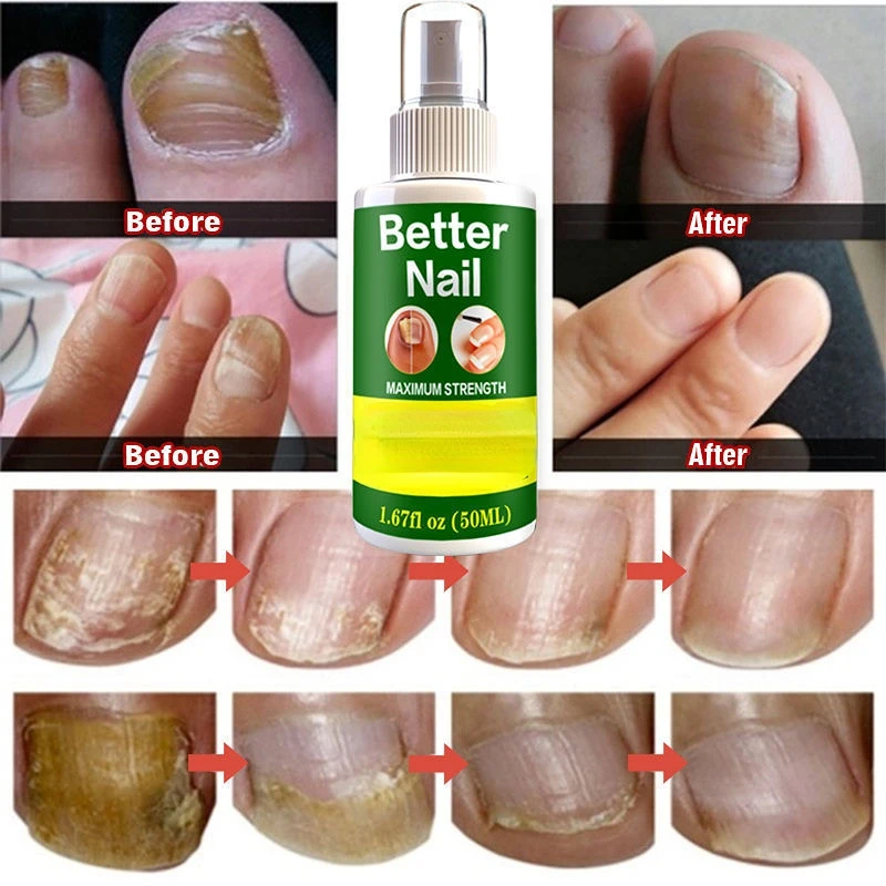 

Fungal Nail Repair Spray Nursing Treatment Foot Nail Fungus Removal Gel Anti-Infective Paronychia Onychomycosis Care